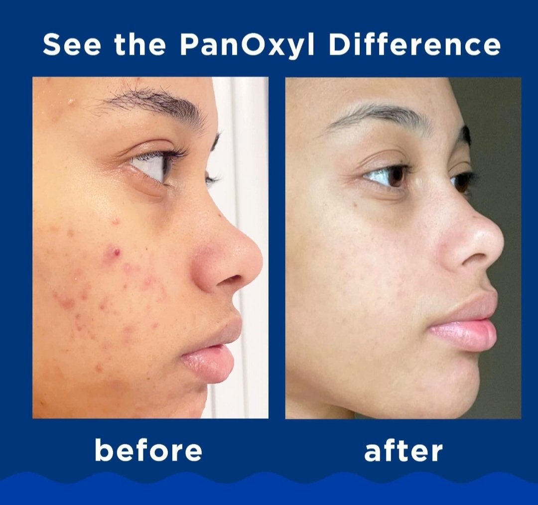 PanOxyl Acne Foaming Wash Benzoyl Peroxide 10% Maximum Strength.