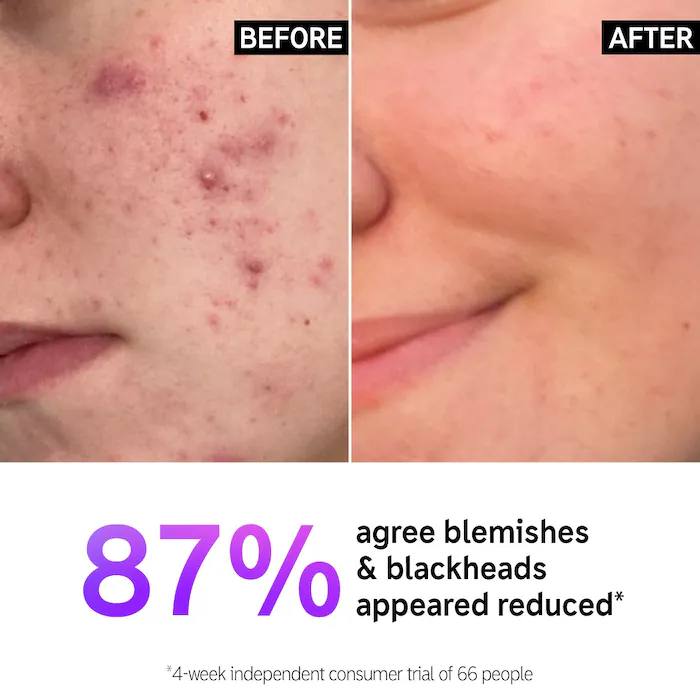 The Inkey List Salicylic Acid Acne + Blackhead Cleanser